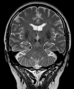 뇌자기공명영상(MRI)촬영